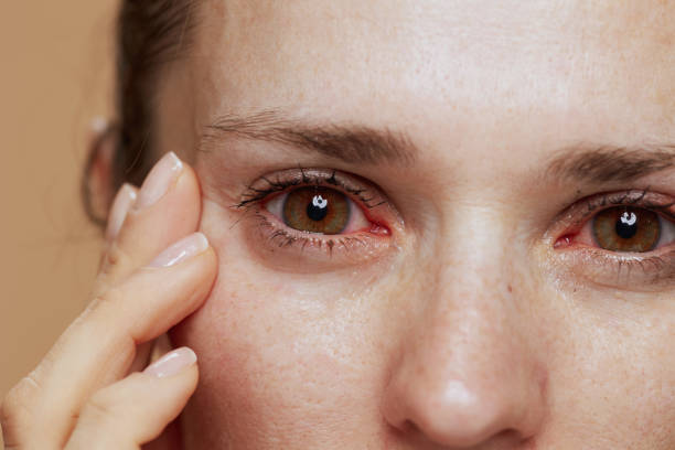 Eye Allergies: What They Are and How to Keep Your Eyes Happy